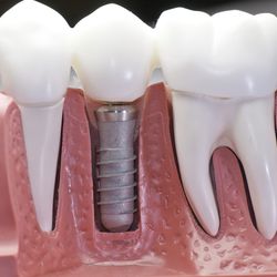 The 3 Types Of Teeth Discoloration