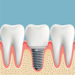 A Dental Implant That Protects Teeth From The Inside