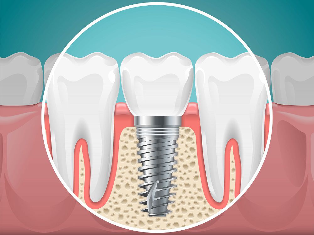 Caring For Dental Implants