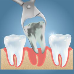 Do You Really Need A Dental Extraction?